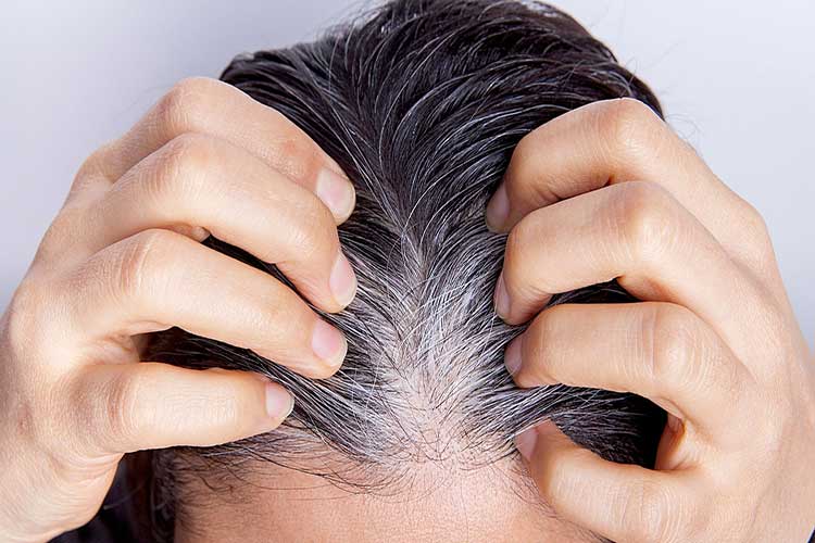 أسباب تساقط الشعر : الصلع من النمط الأنثوي أو الذكري